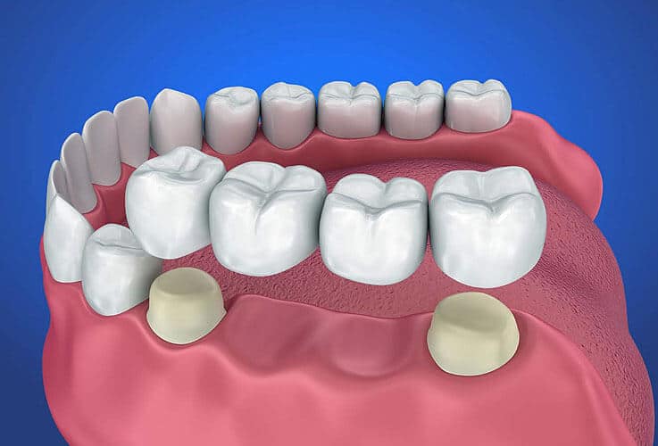3D dental model showing tooth implants, crowns, and bridgework on pink gum base against blue background.