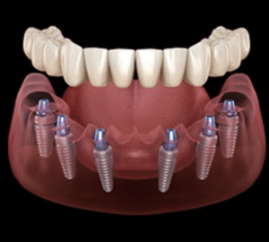 The Top 10 Impressive Benefits of Dental Implants