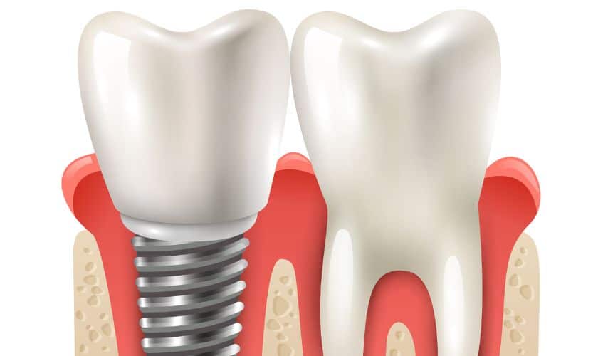 Dental implants