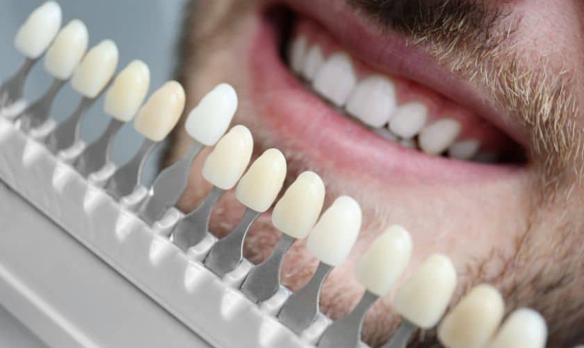 Veneers For Wedding Bliss: Achieving Your Dream Smile For The Big Day