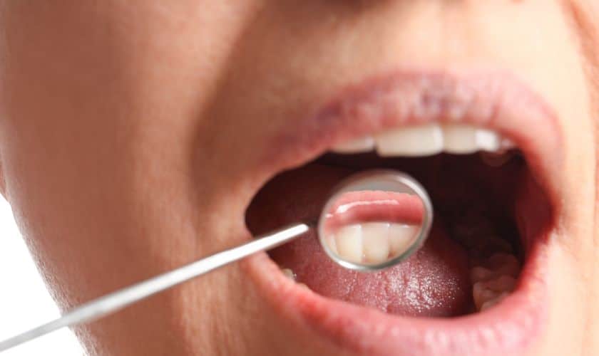 Close-up of open mouth during dental examination with mirror tool inserted.
