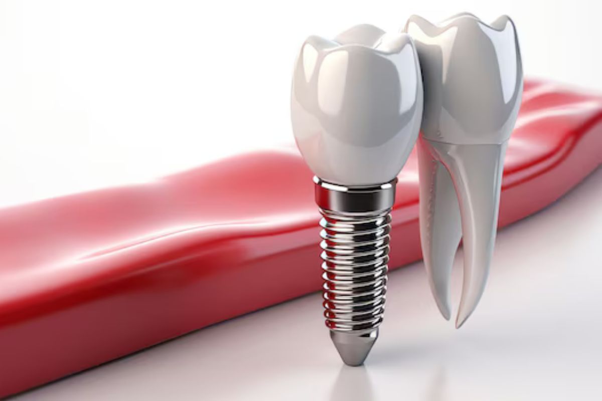 Dental Implants