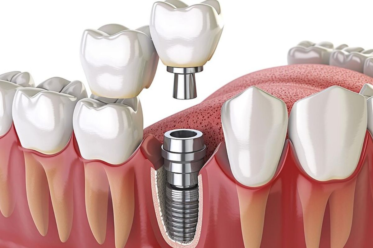 Dental Implants