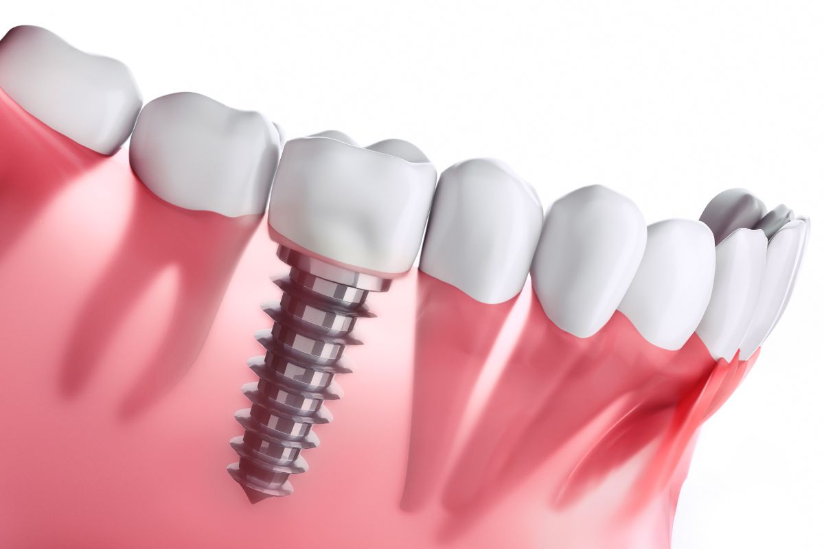 dental-implants