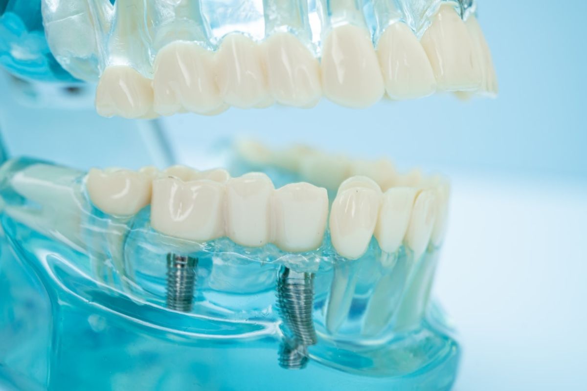 Can Dental Implants Get Infected