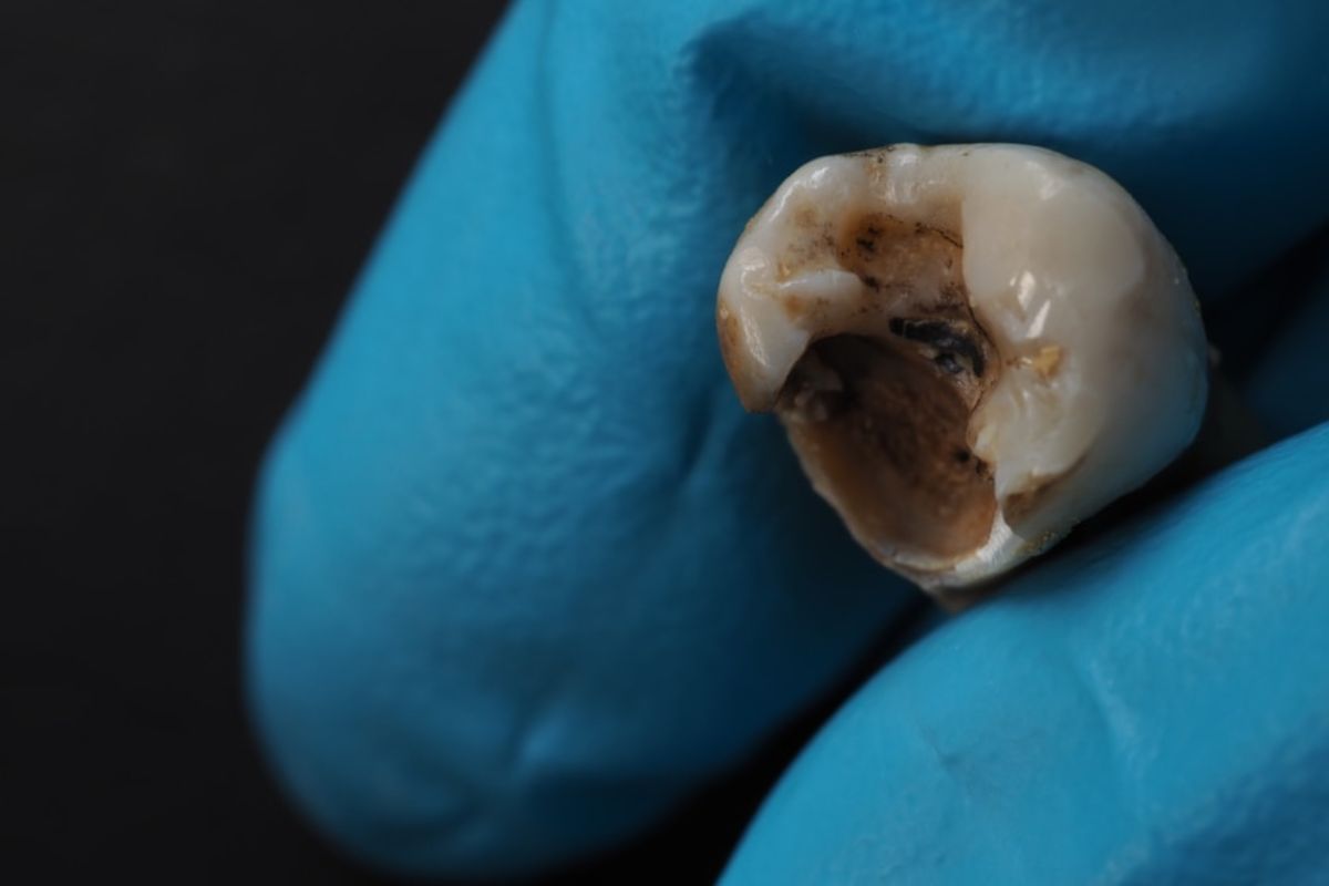 Can Rotten Teeth Be Saved