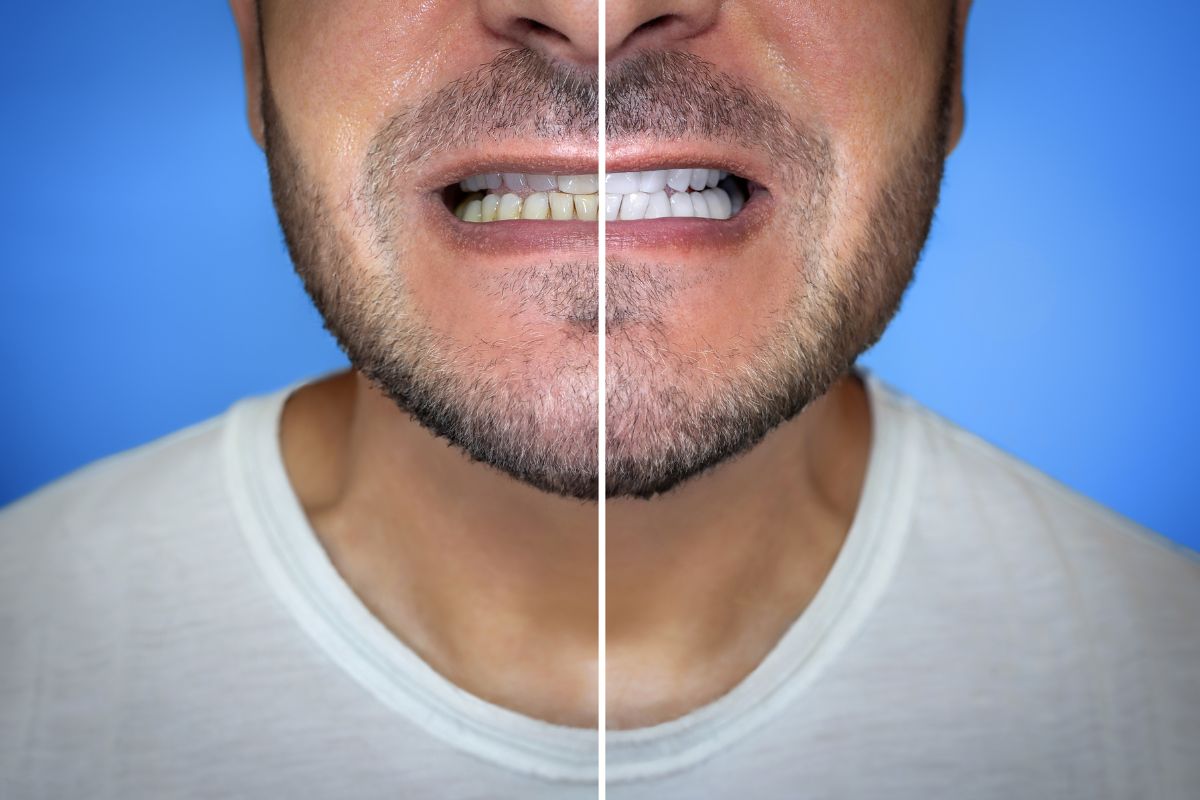 Does Teeth Whitening Damage Enamel San Antonio