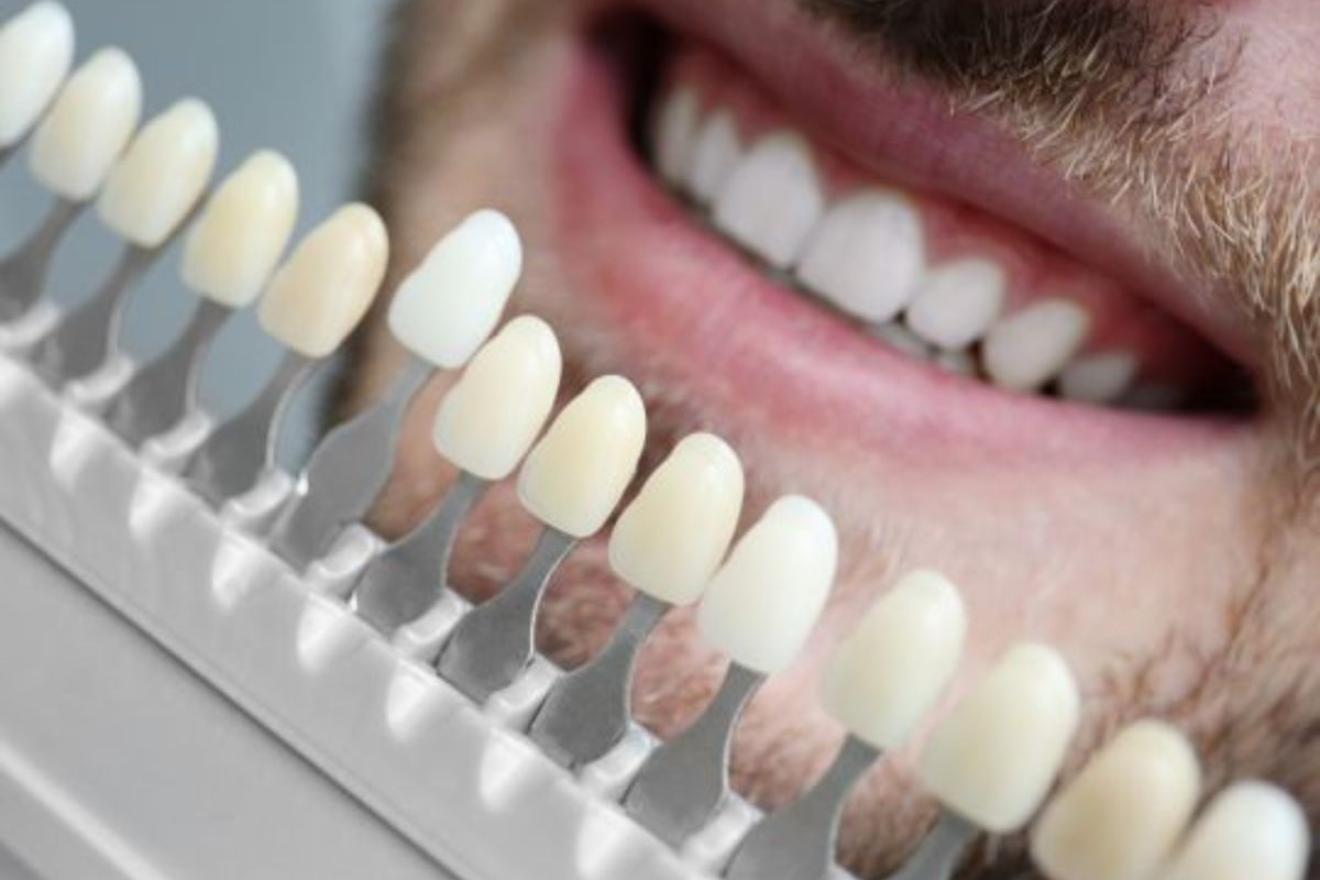 Are Veneers Permanent