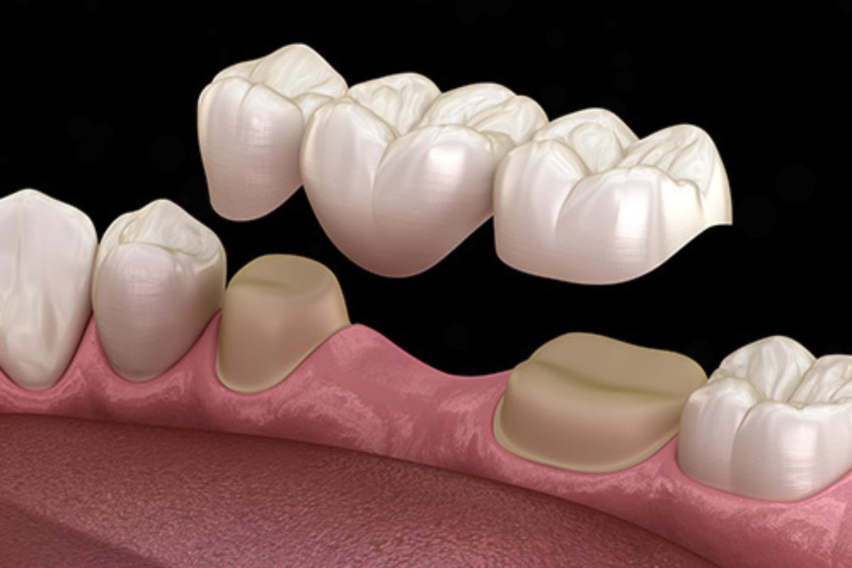 Is a Dental Bridge Permanent San Antonio