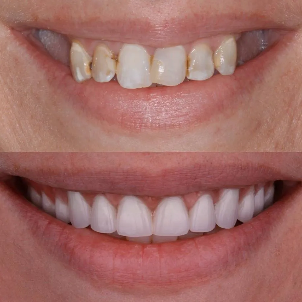 Before and after comparison of teeth whitening results showing discolored teeth transformed to bright white smile.
