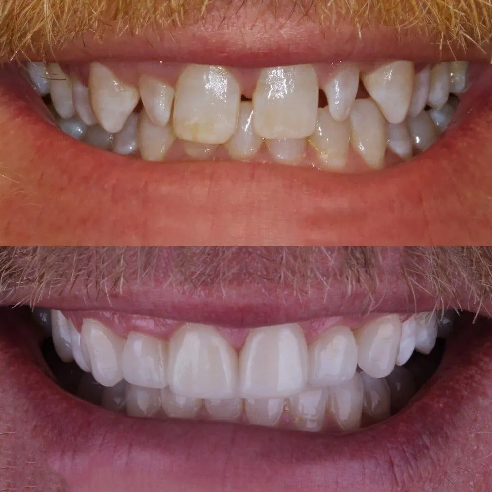 Before and after dental treatment showing improved tooth alignment and whiteness.