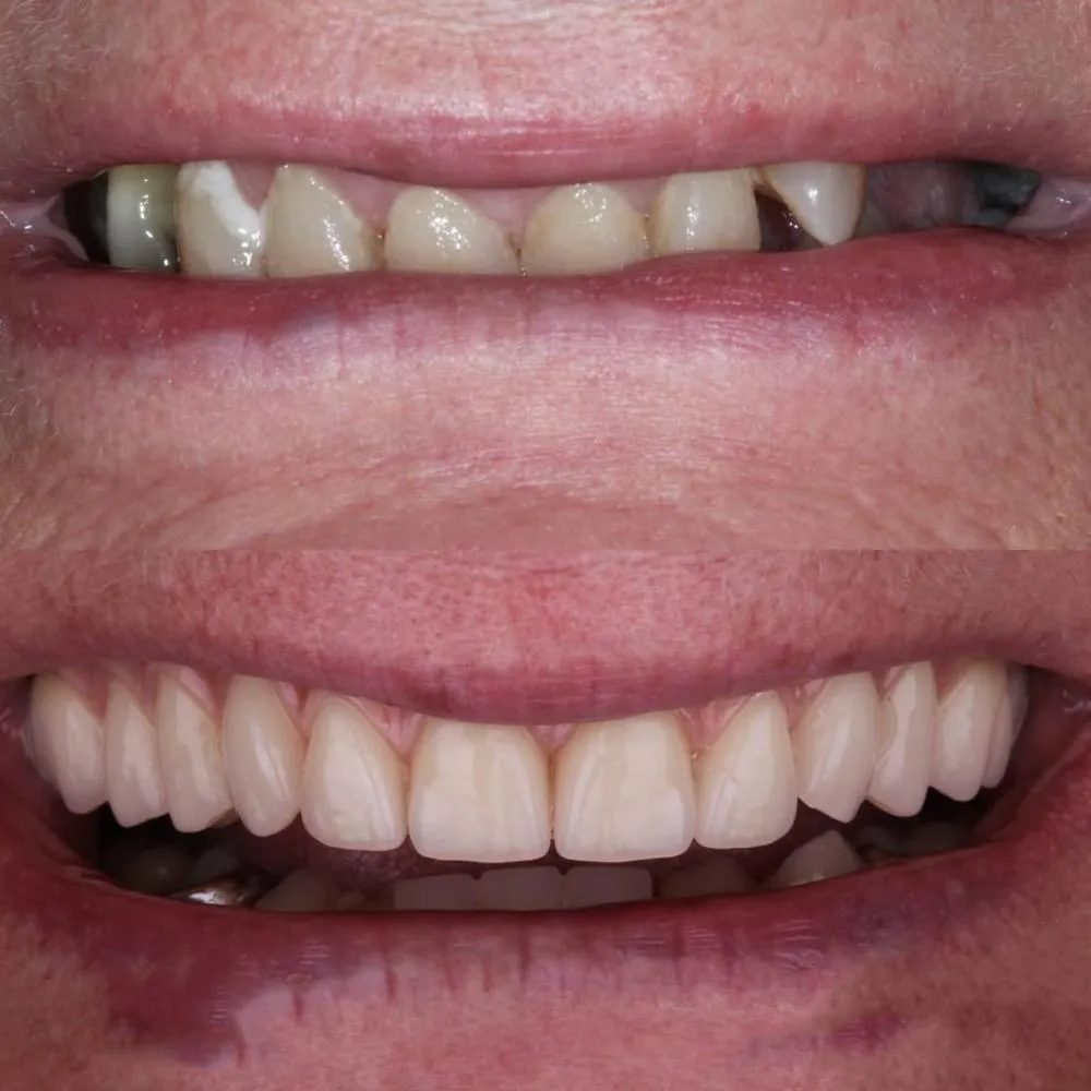 Before and after dental restoration showing improved teeth alignment and whiteness.