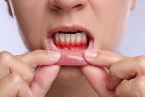 How a Dentist Can Help with Gum Disease Early