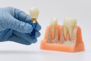 How bone loss affects dental implant success